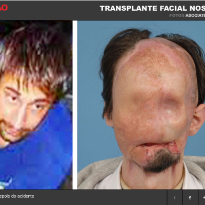Transplante do rosto….